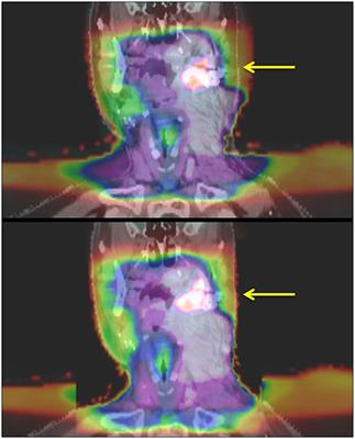 Quality of <mark class="highlighted">Life Outcomes</mark> Following Organ-Sparing SBRT in Previously Irradiated Recurrent Head and Neck Cancer